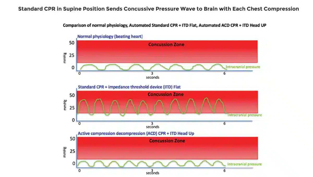 CPR Induced Concussion