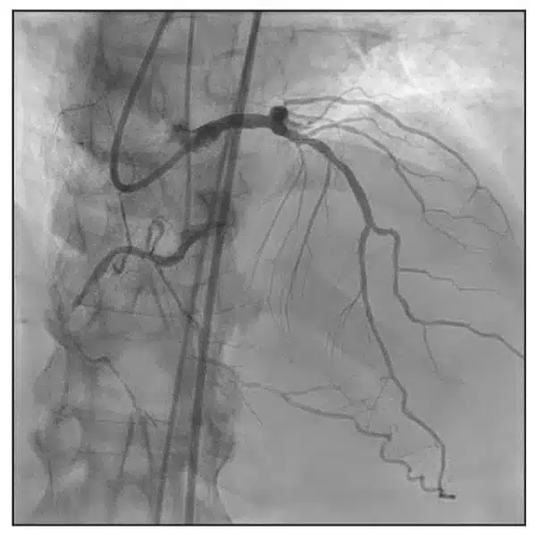 subacute occlusion of the proximal circumflex and a proximal CTO of the dominant RCA with a collateral network primarily via the patent left anterior descending (LAD) artery system