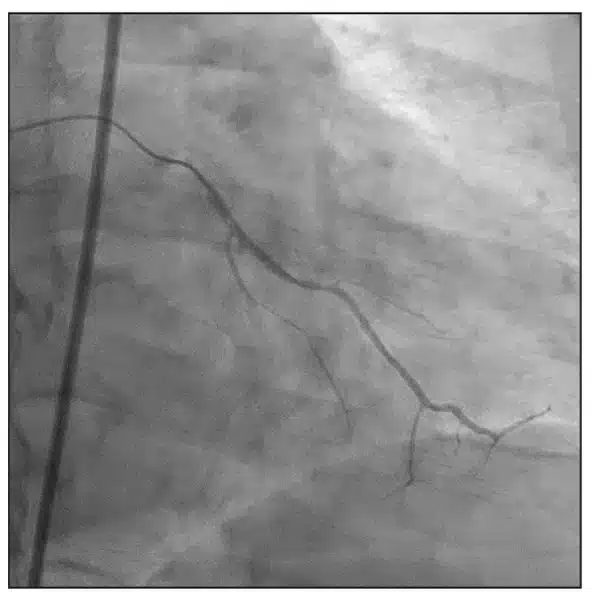 distal intraluminal position was confirmed with contrast injection thru the Corsair microcatheter