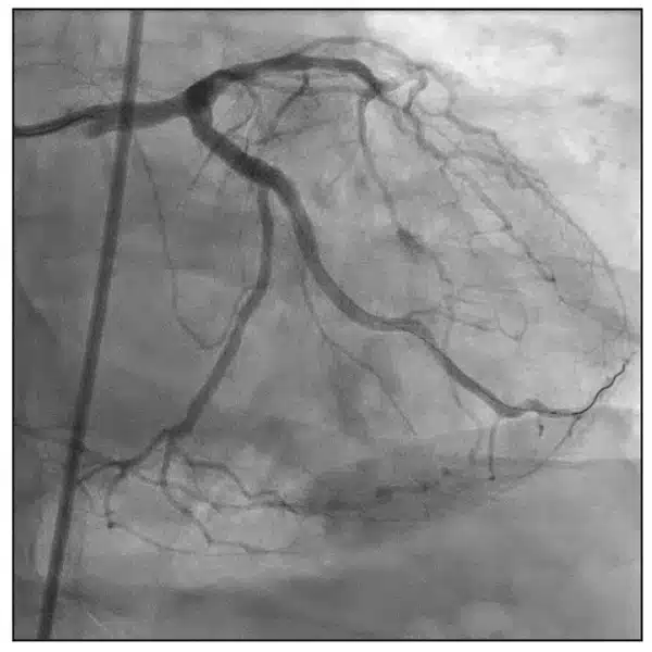 intravascular ultrasound (IVUS) confirmed good stent-to-wall apposition