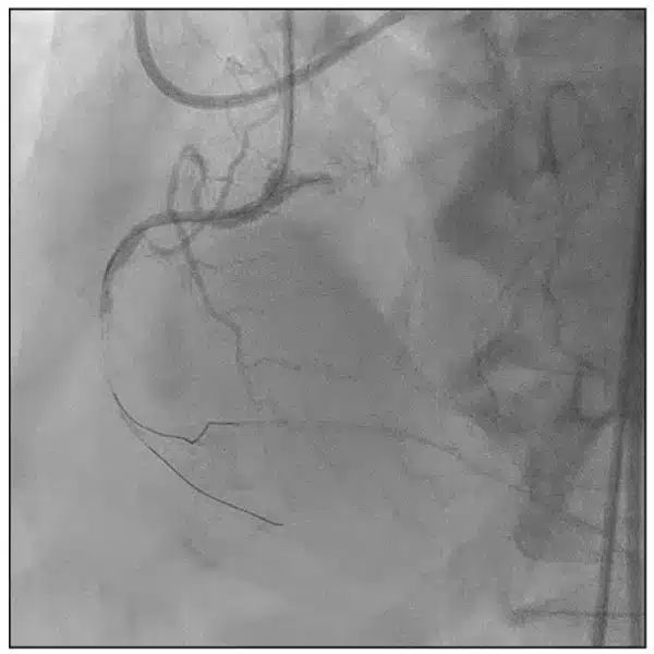 The PDA retrograde wire placement (Figure 5) allowed for target positioning of an antegrade Hi-Torque Pilot 200 wire from the proximal RCA to cross the lesion and position it in the PDA to complete the intervention
