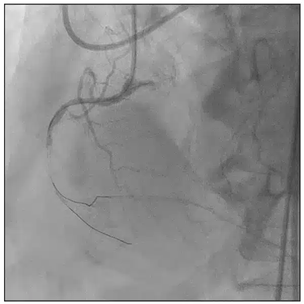 Case-Study-Figure-5 The PDA retrograde wire placement (Figure 5) allowed for target positioning of an antegrade Hi-Torque Pilot 200 wire from the proximal RCA to cross the lesion and position it in the PDA to complete the intervention
