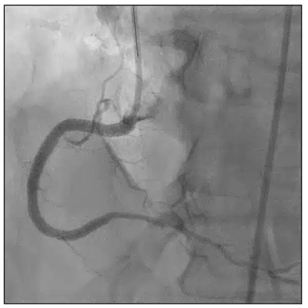 Case-Study-Figure-6 Successful stent placement was completed to the RCA with three overlapping Synergy stents measuring 3.5 X 48 mm, 4.0 X 32 mm, and 5.0 X 8 mm from distal to proximal