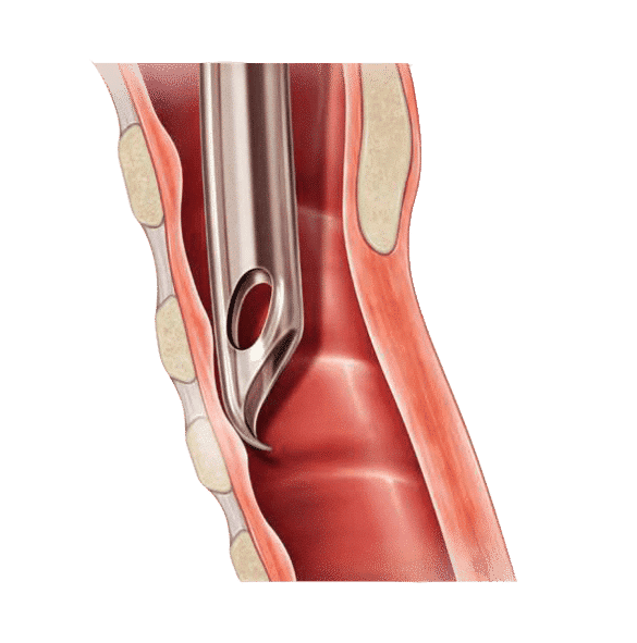 parker ETT tube in airway