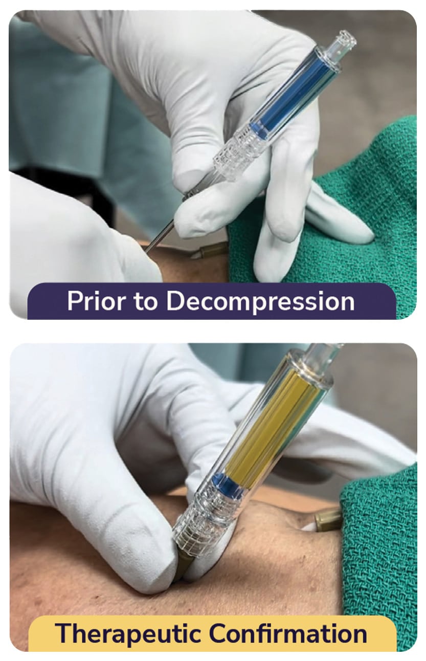 Before and After Pneumothorax Decompression