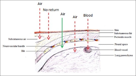 Needle Thoracostomy Placement