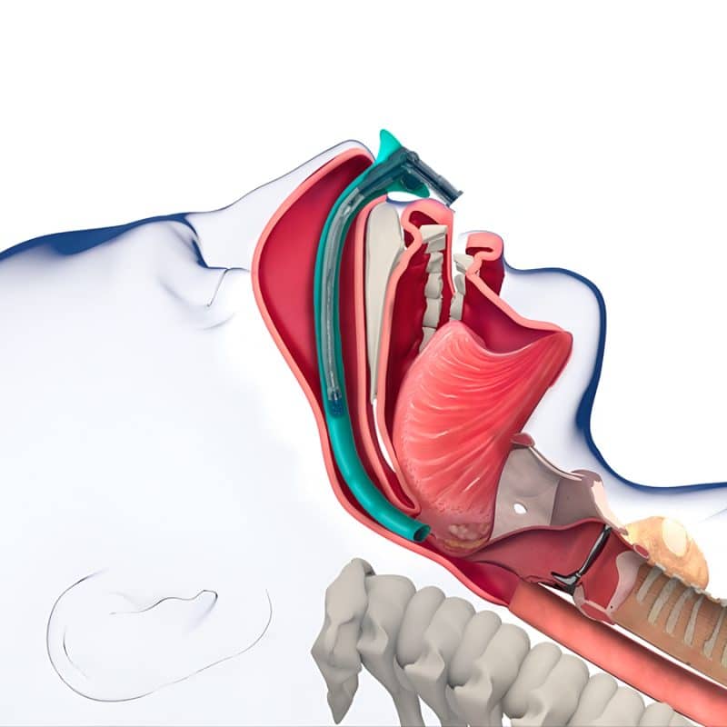 Aeris Airway Device from Airway Innovations