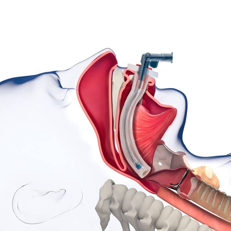 Aeris Airway Device from Airway Innovations