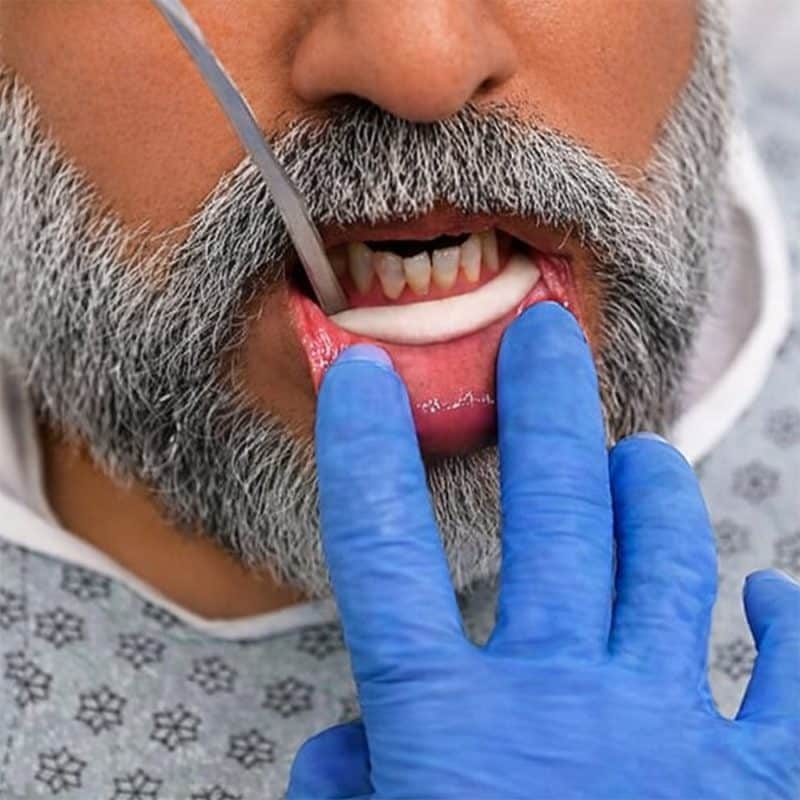 Patient with SWIK in the mouth