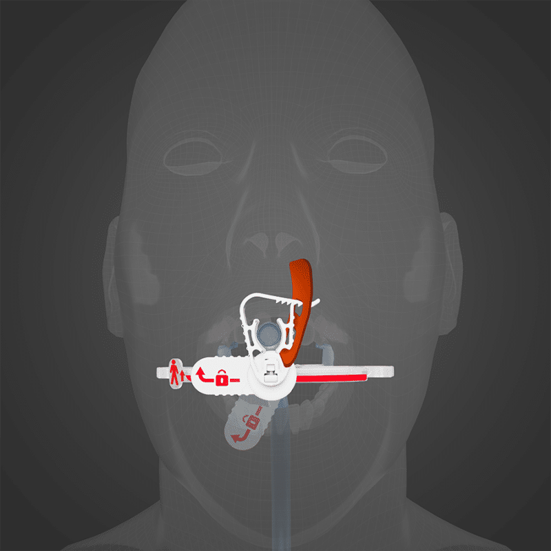 The Horseshoe from Surgicure Technologies