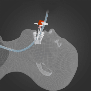 HORSESHOE-Product-Photo-Profile-Inserted-900x900 The Horseshoe from Surgicure Technologies - Inserted