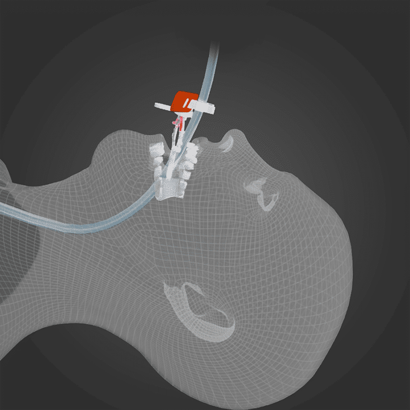 The Horseshoe from Surgicure Technologies - Inserted