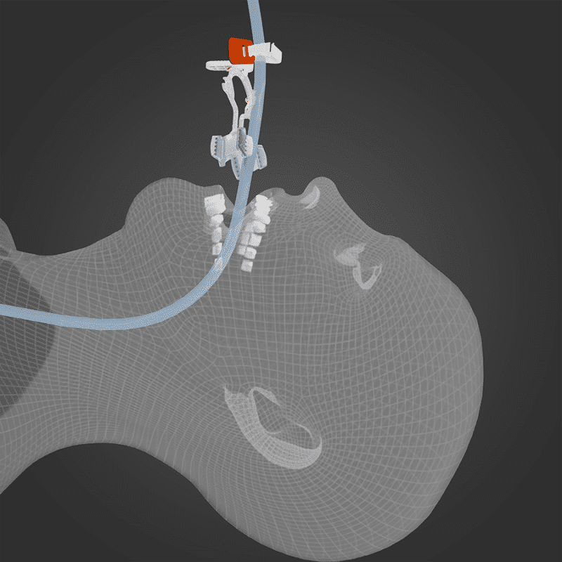 The HORSESHOE™ from Surgicure Technologies